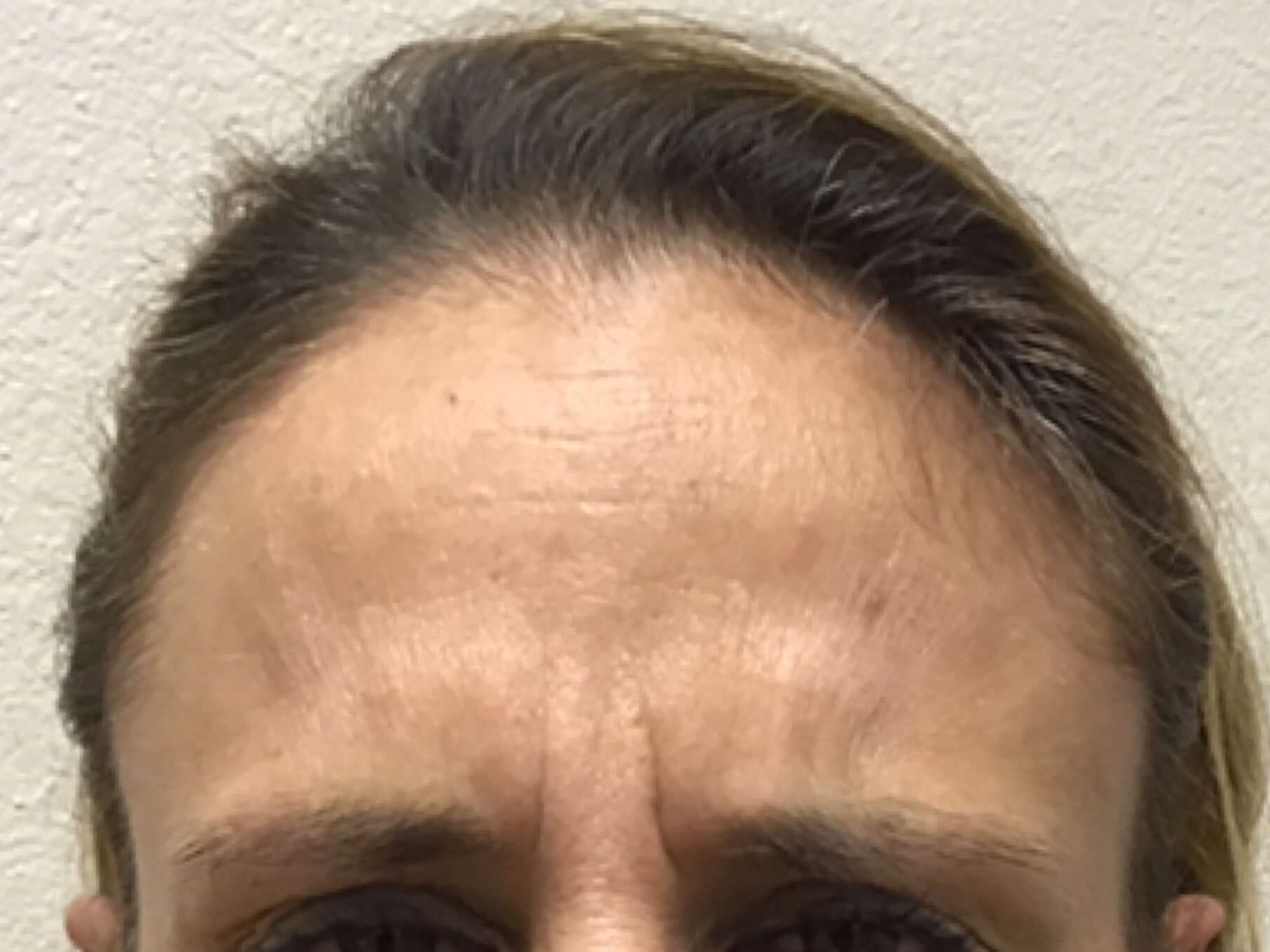 Before and After Botox After