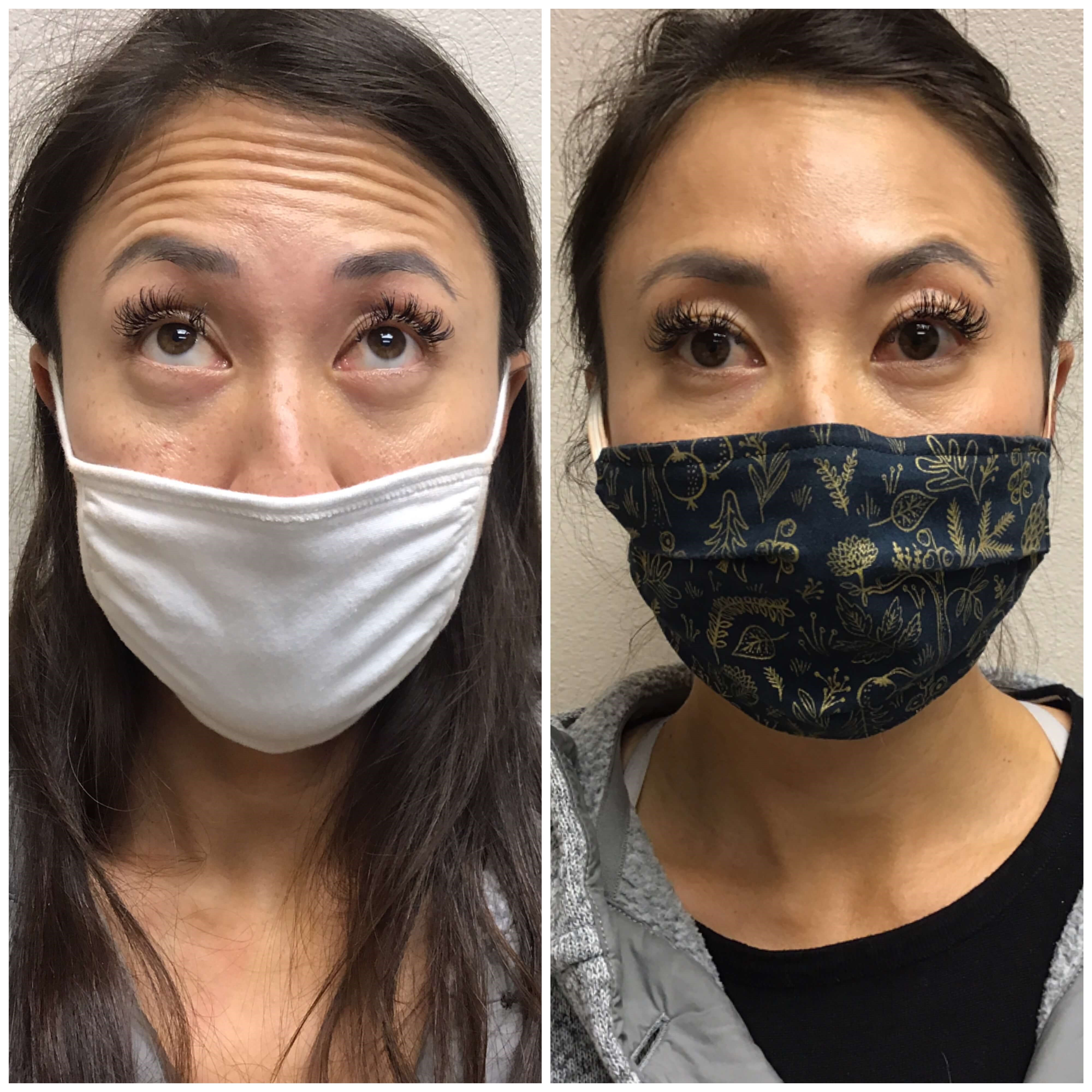 Before and After Botox Before