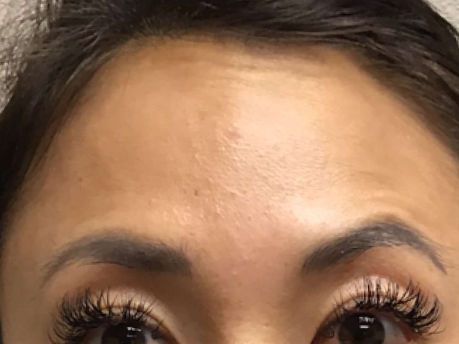 Before and After Botox After