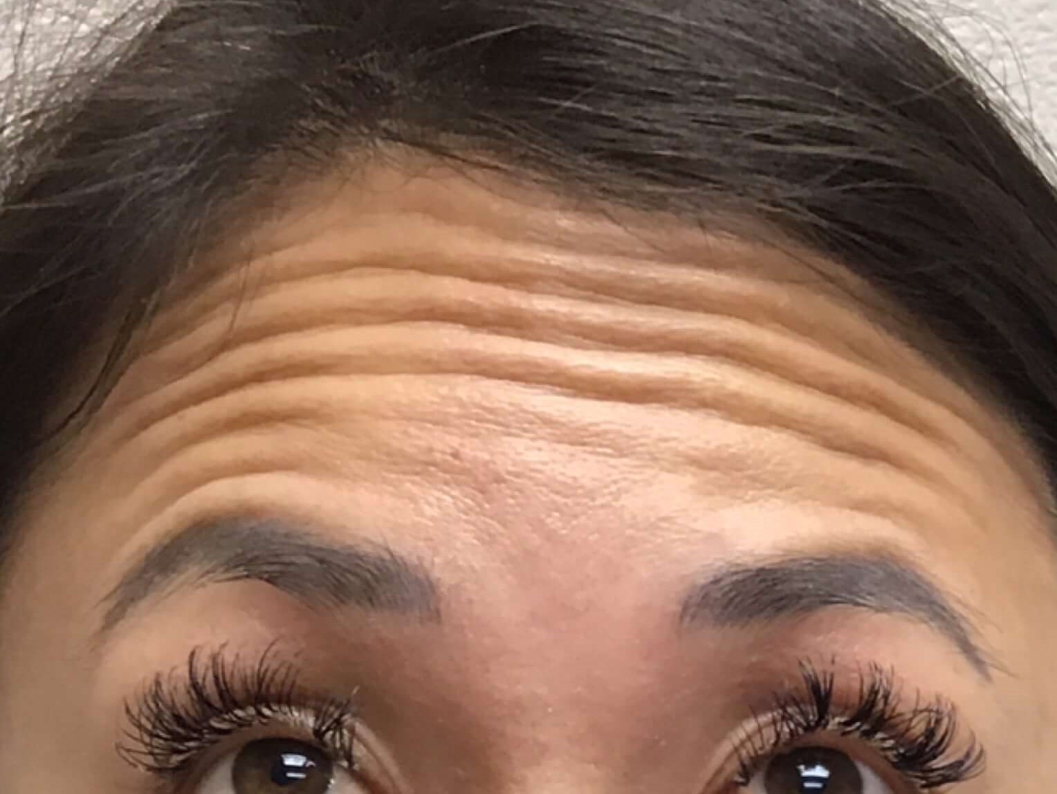 Before and After Botox Before