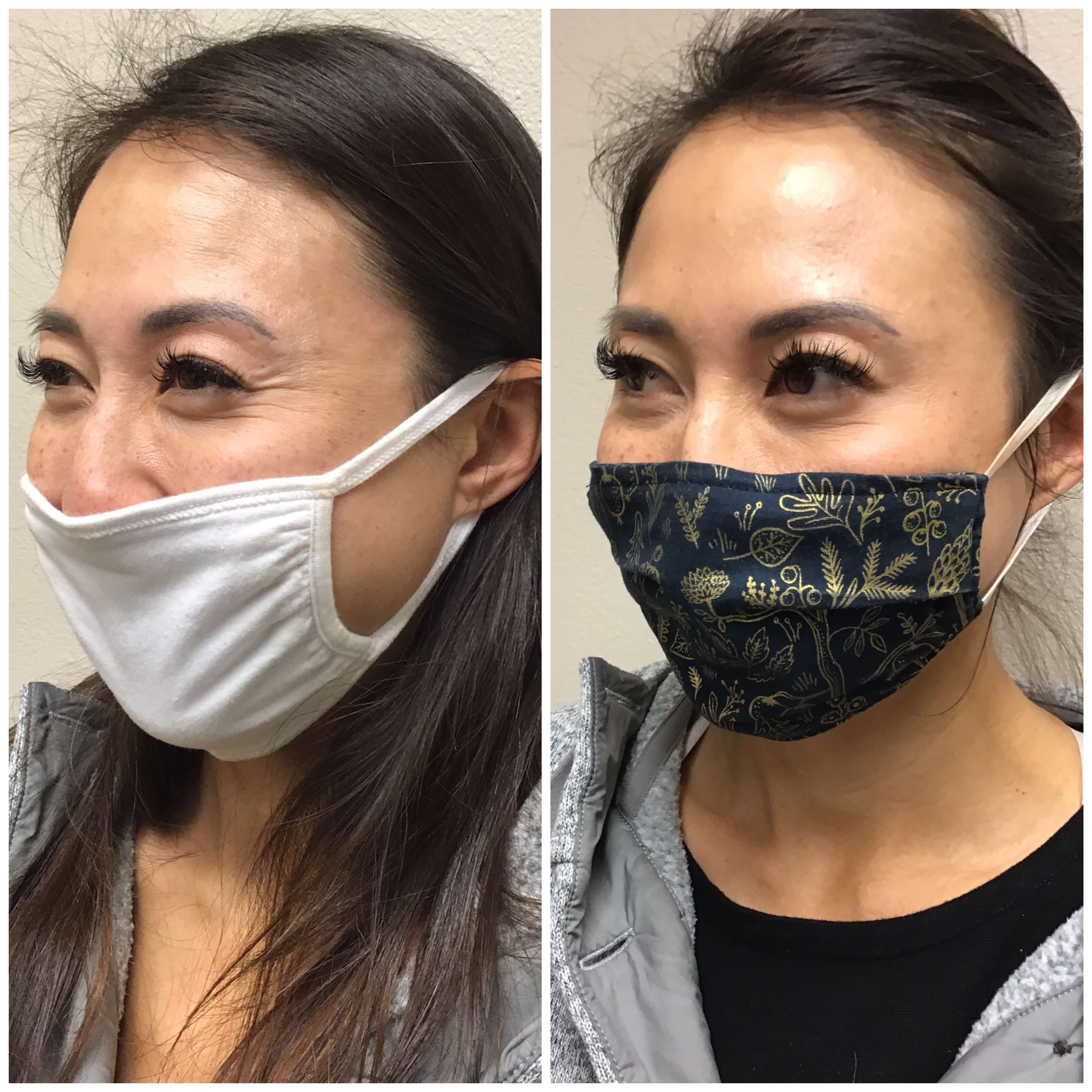 Before and After Botox Before