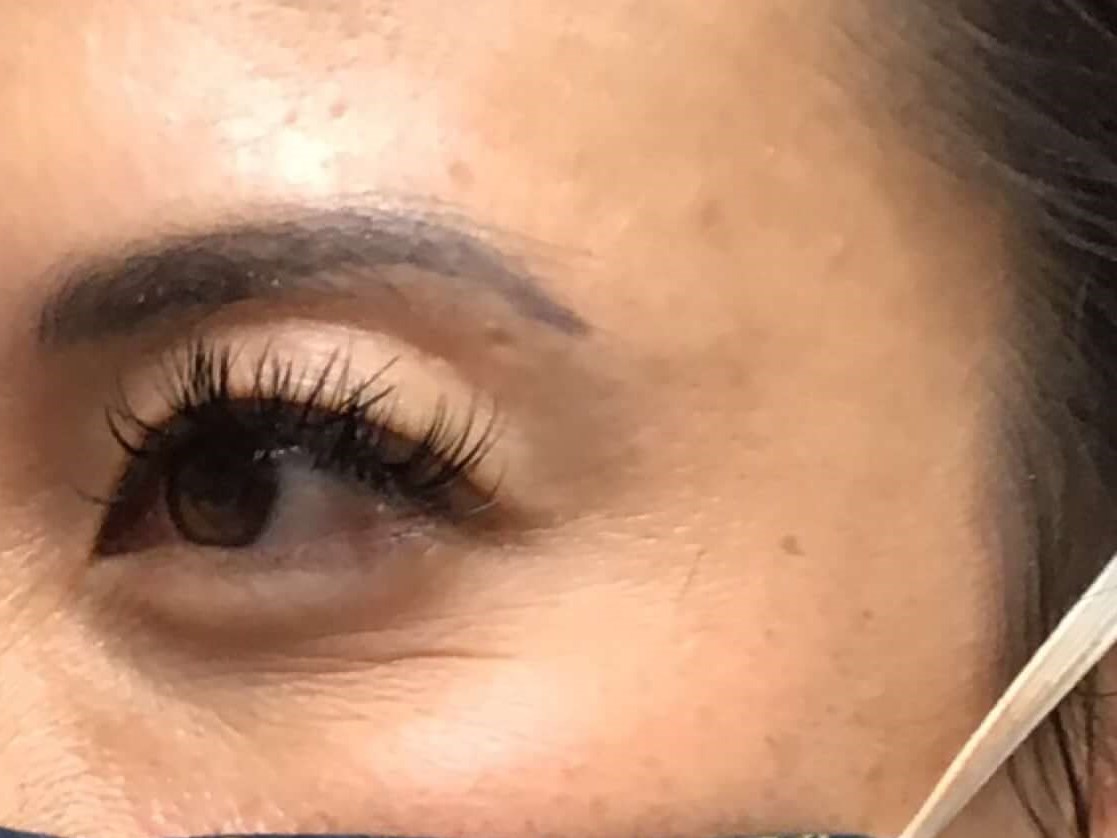 Before and After Botox After