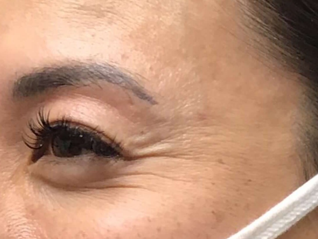 Before and After Botox Before