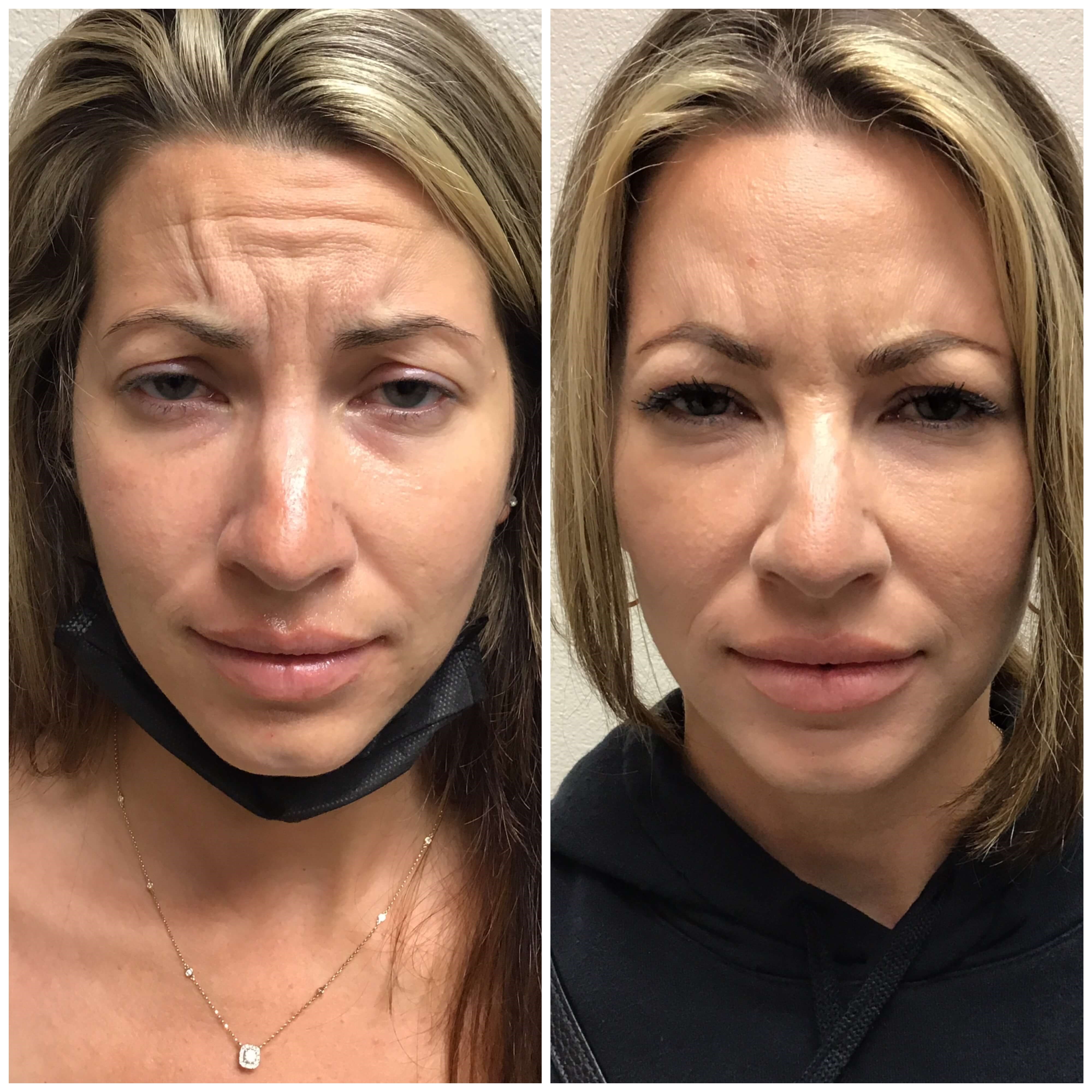 Before and After Botox Before