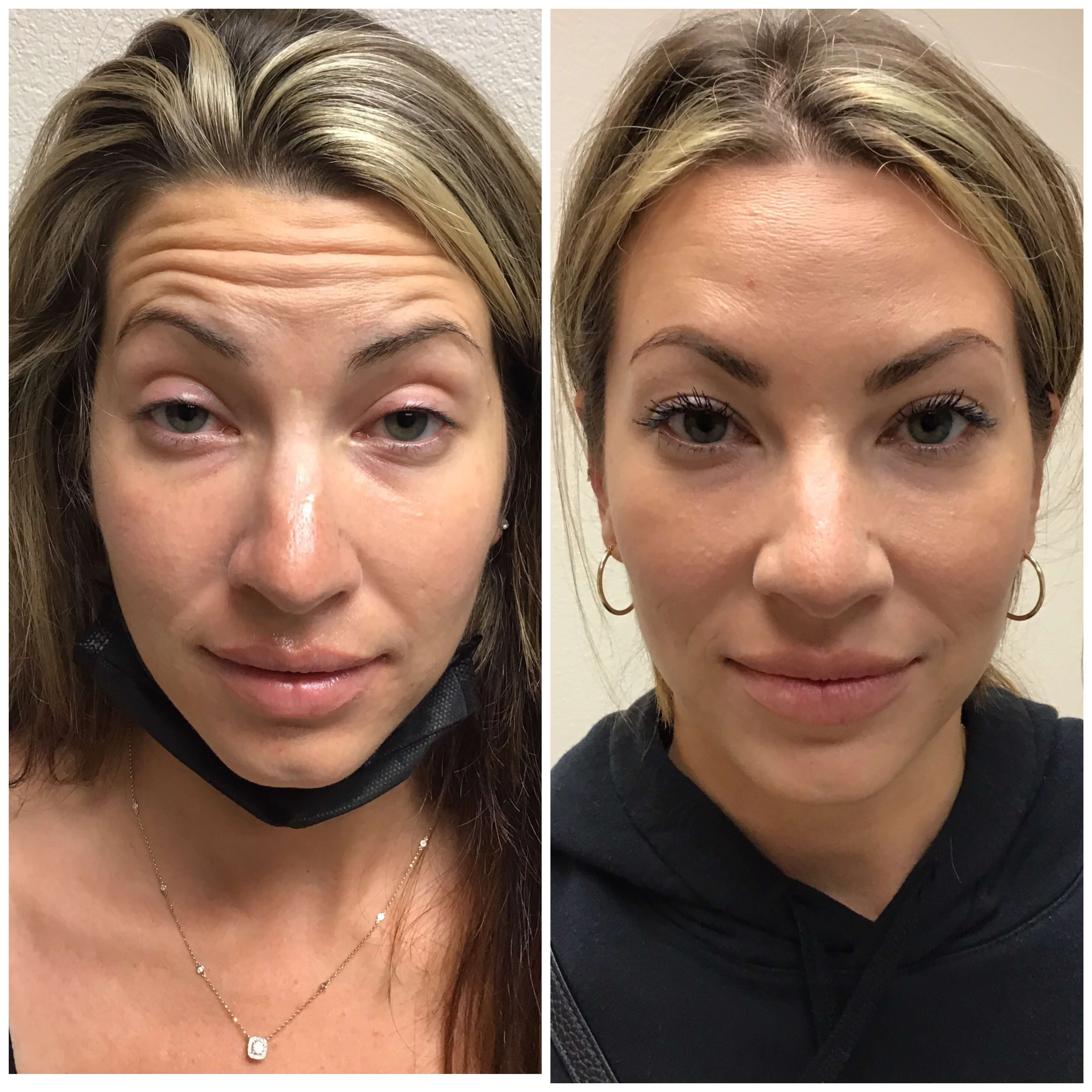 Before and After Botox Before
