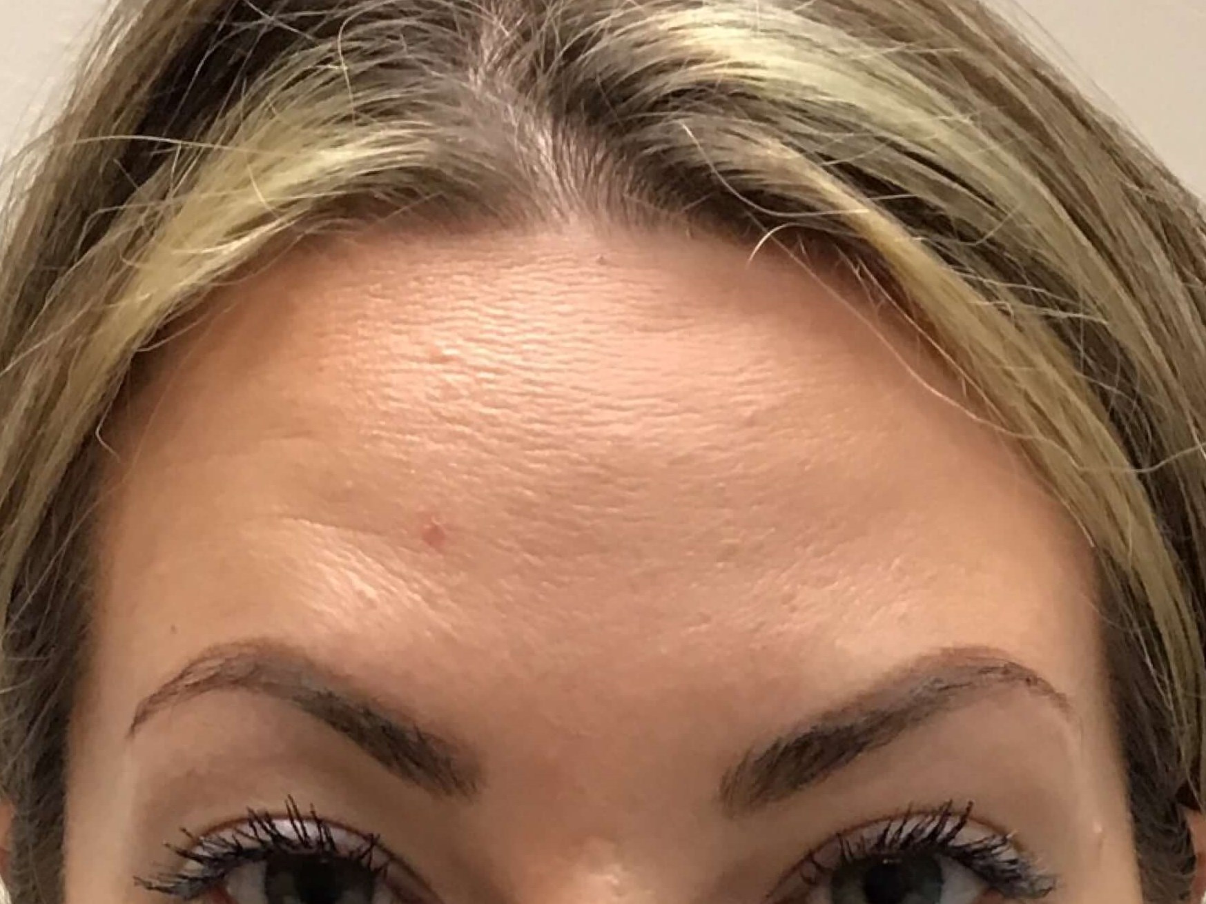 Before and After Botox After