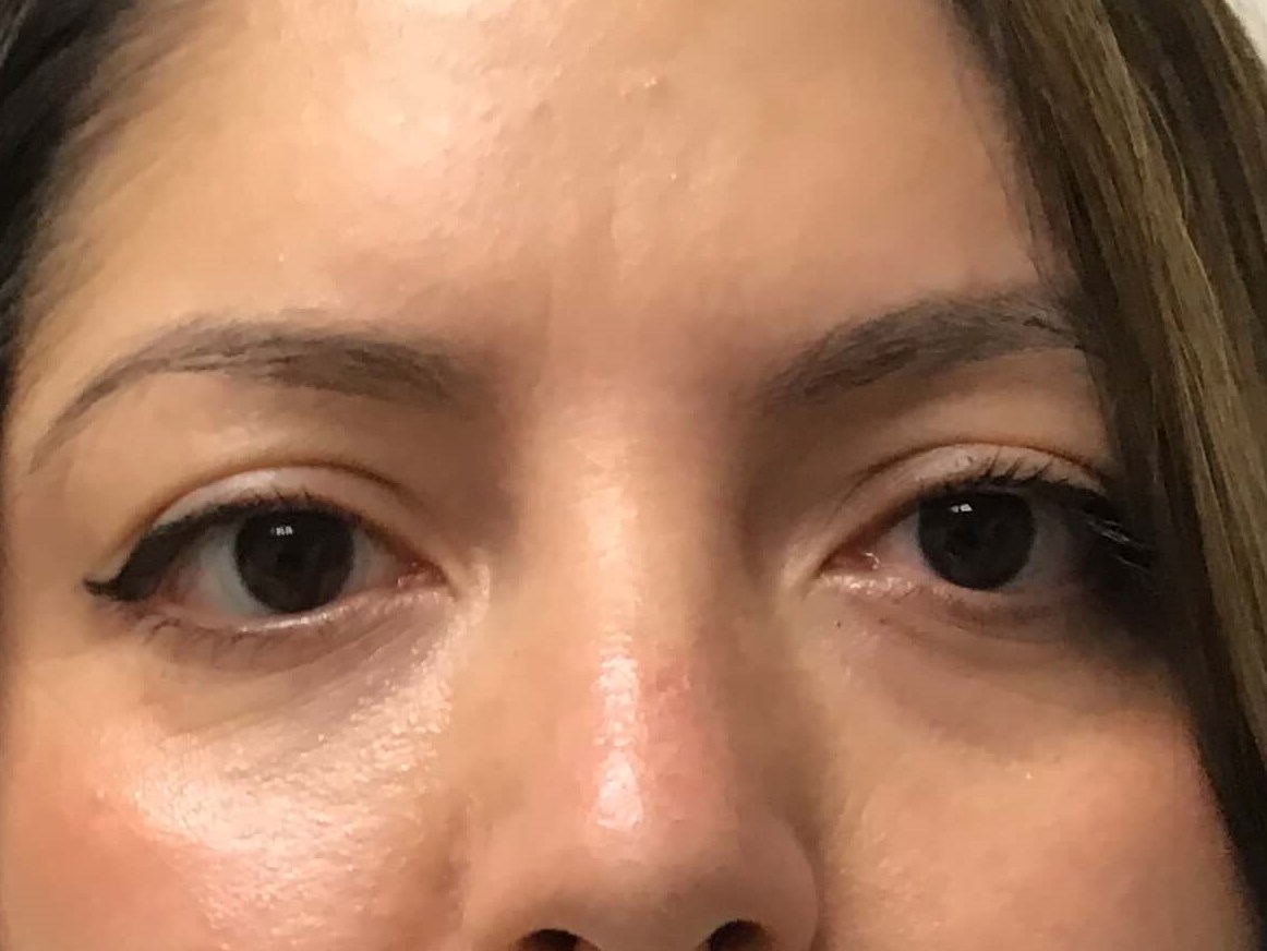 Before and After Filler After