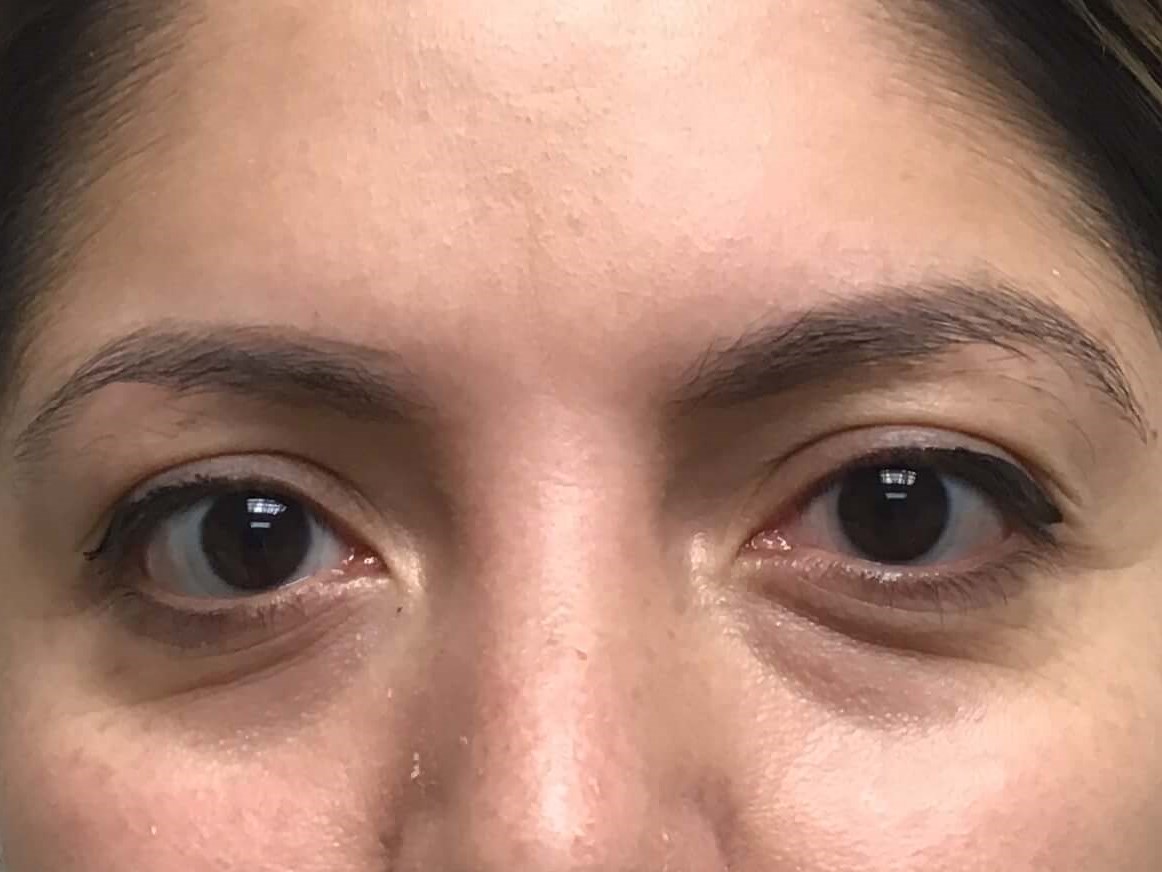 Before and After Filler Before