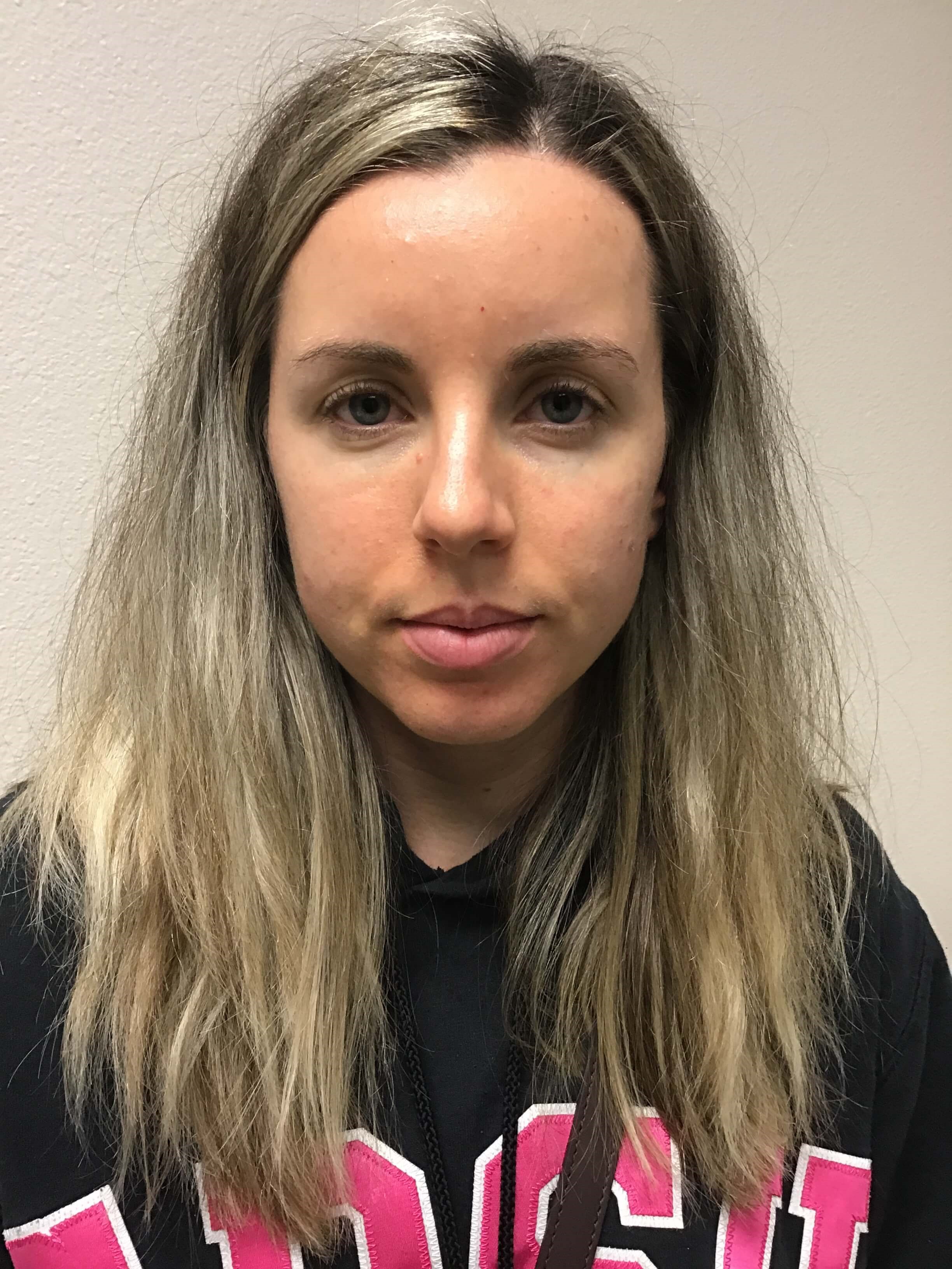 Before and After Filler After