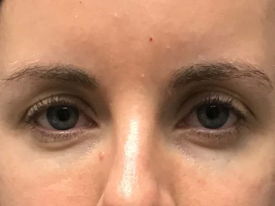 Before and After Filler After