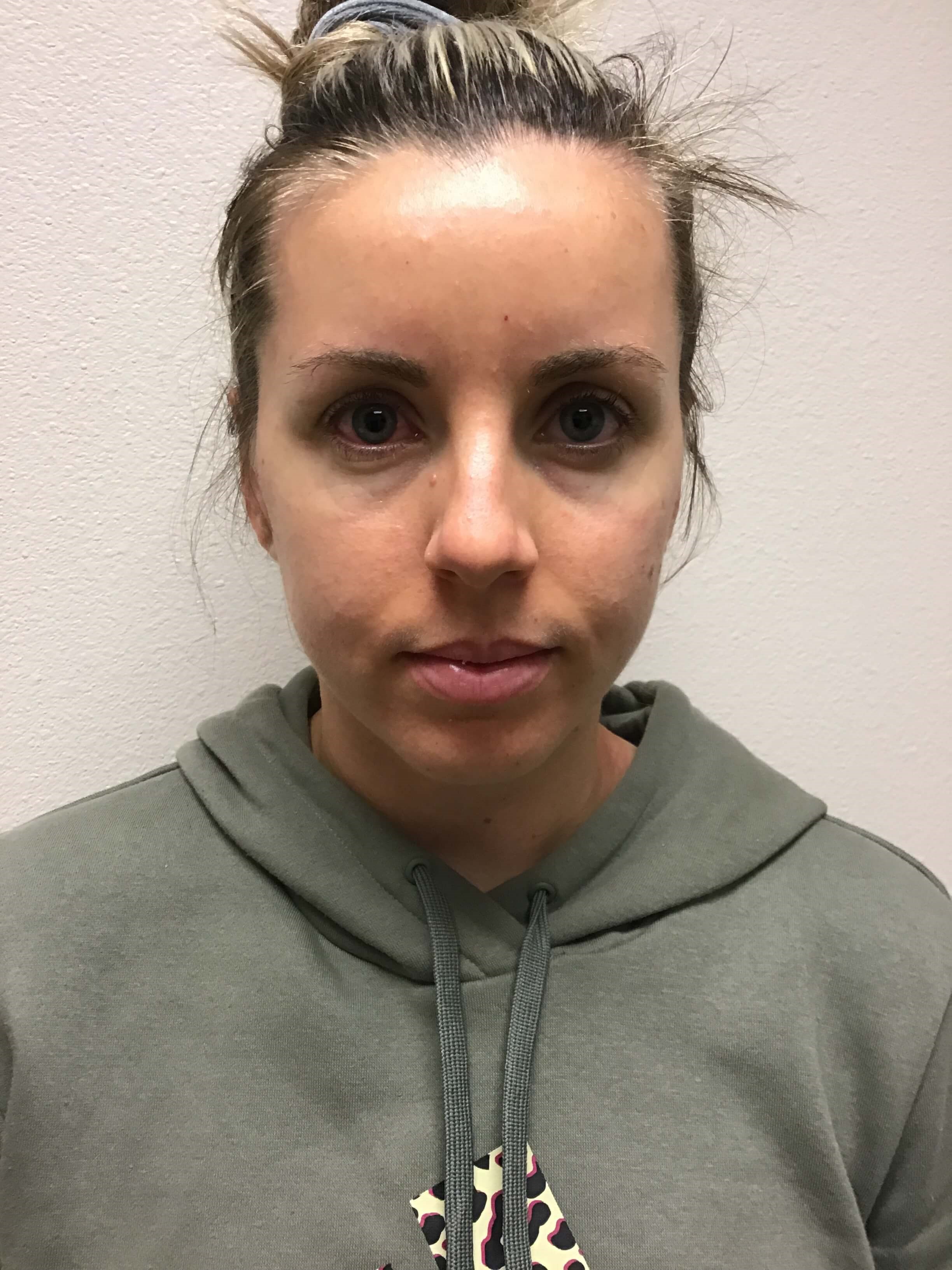 Before and After Filler Before