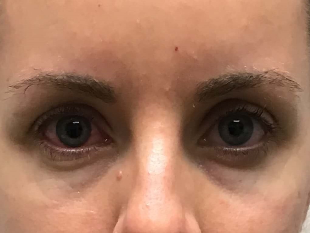 Before and After Filler Before