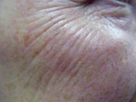 Before and After Laser Before