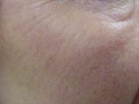 Before and After Laser After