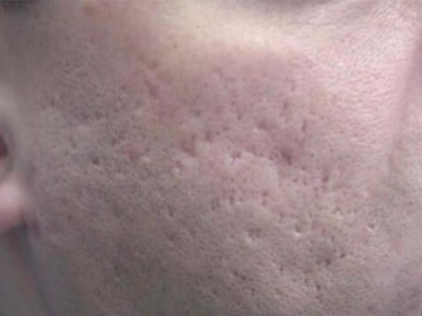 Laser Skin Resurfacing Before