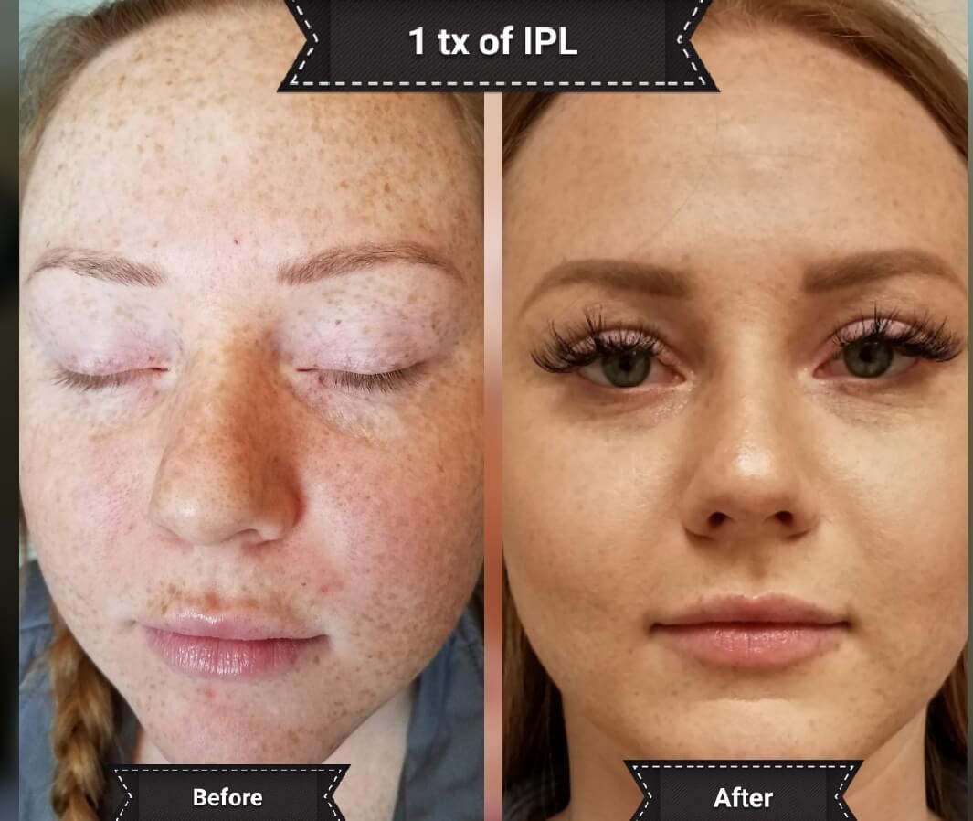 Before & After Chemical Peel Before