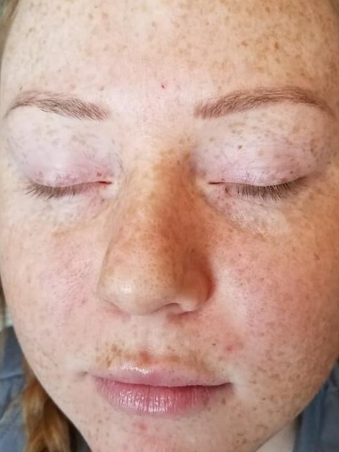 Before & After Chemical Peel Before