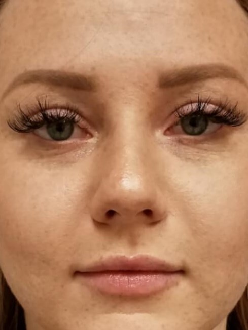 Before & After Chemical Peel After