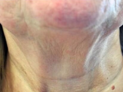 Before & After Laser After