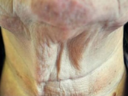 Before & After Laser Before