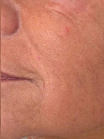 Before and After Laser After