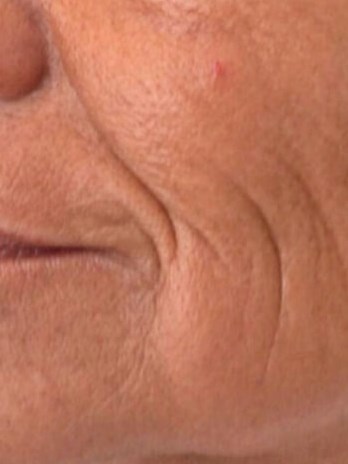 Before and After Laser Before