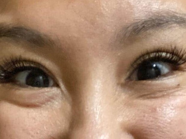 Before and After Botox After