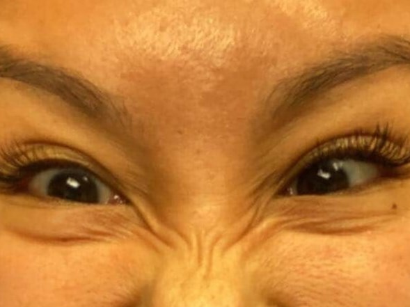 Before and After Botox Before