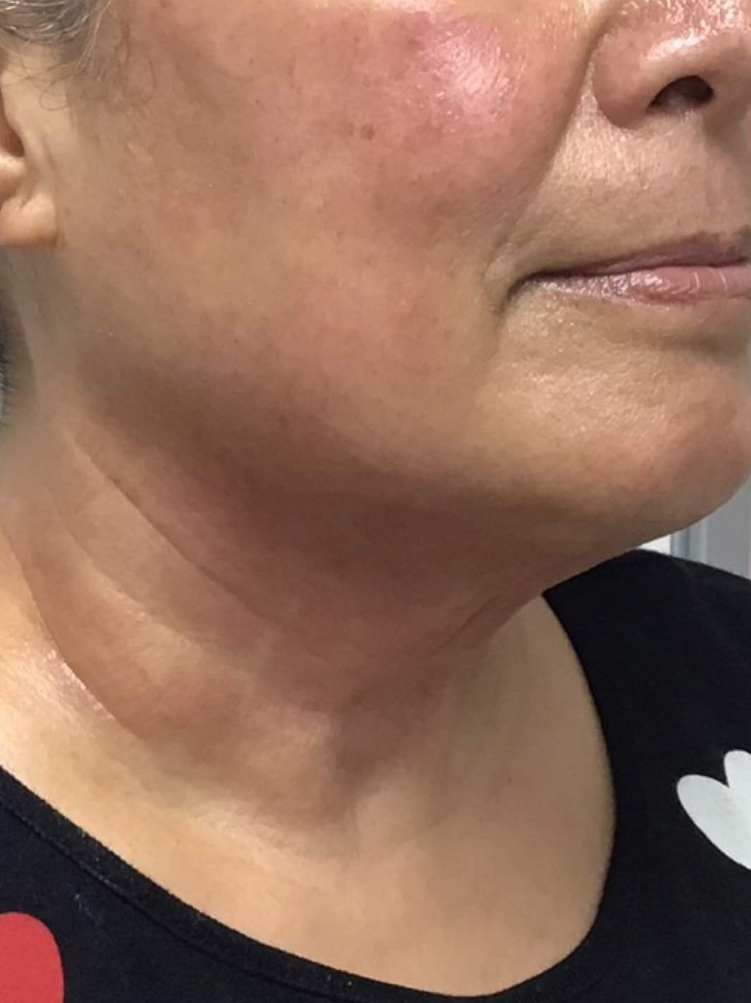 Before & After Laser After