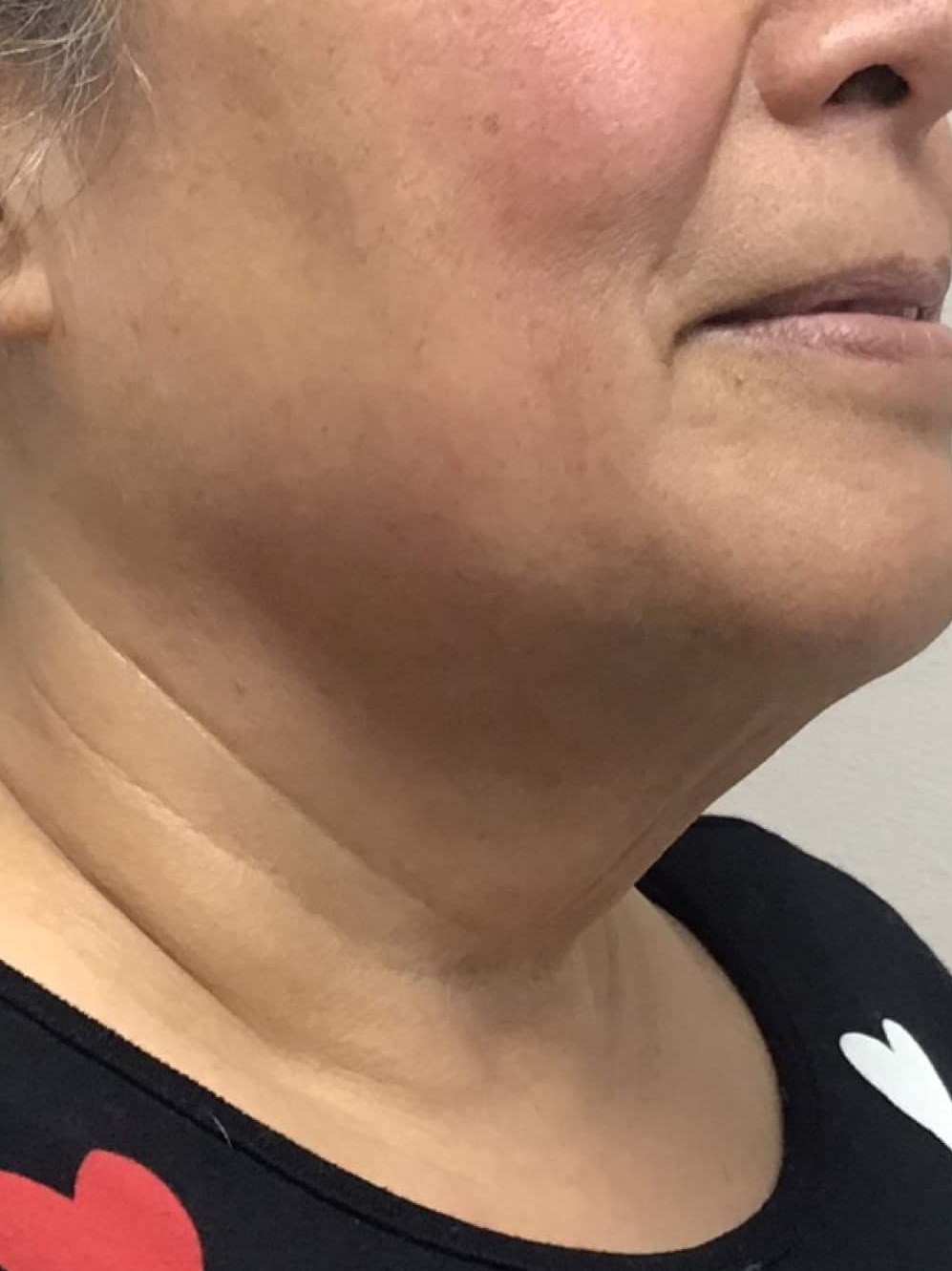 Before & After Laser Before