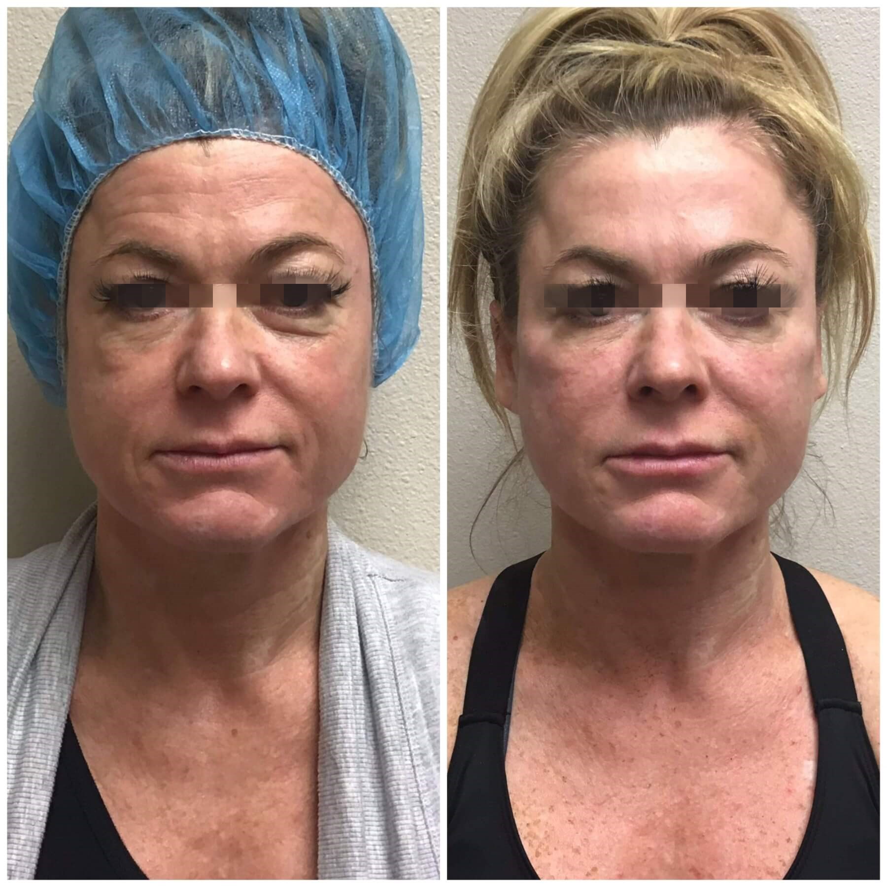 Before & After Cheek Filler Before