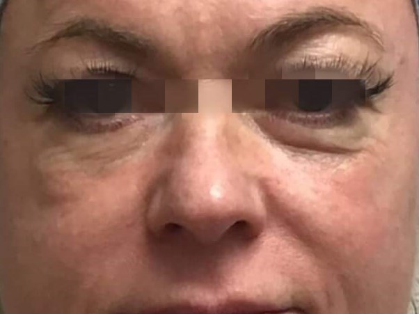 Before & After Cheek Filler Before