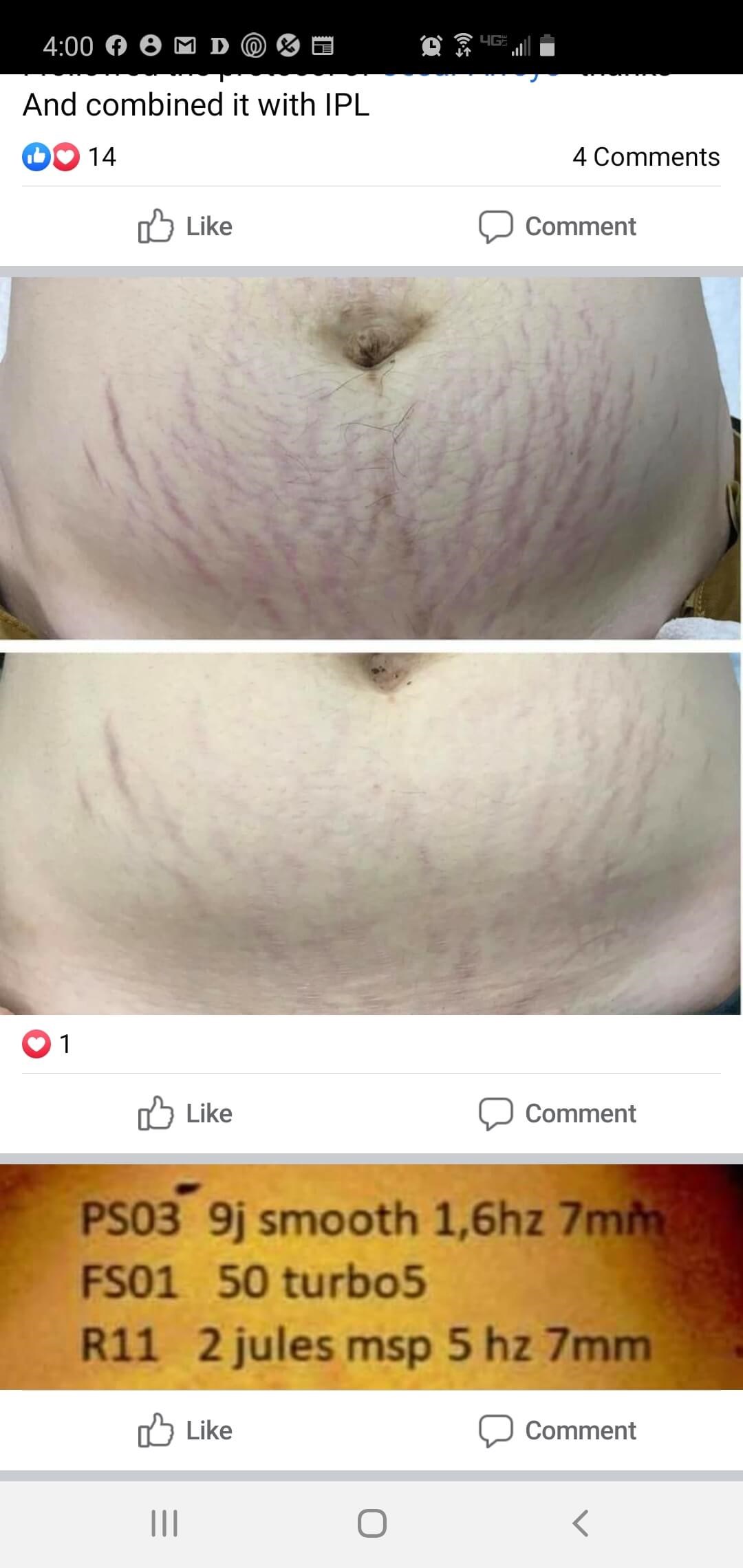 Before & After Laser Before