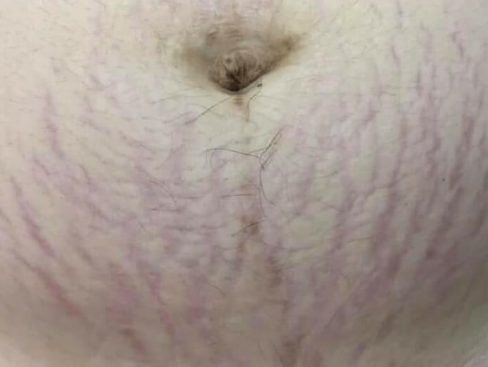 Before & After Laser Before