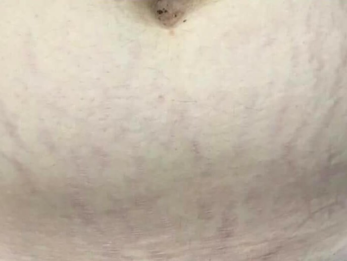 Before & After Laser After