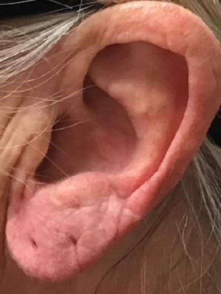 Before and After Ear Filler After