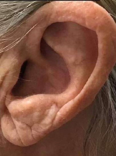 Before and After Ear Filler Before