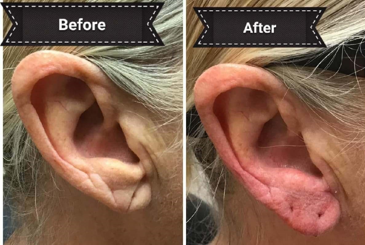 Before and After Ear Filler Before