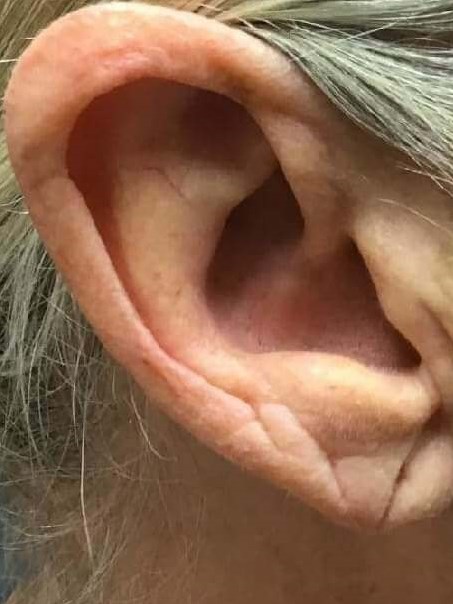 Before and After Ear Filler Before