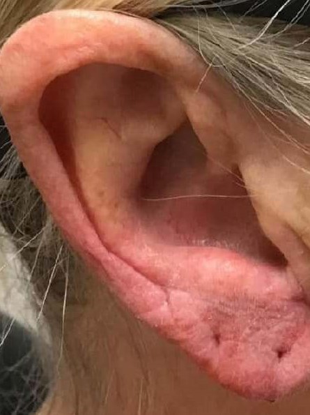 Before and After Ear Filler After