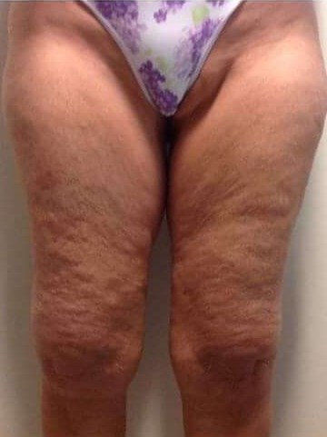 Before & After Laser Before