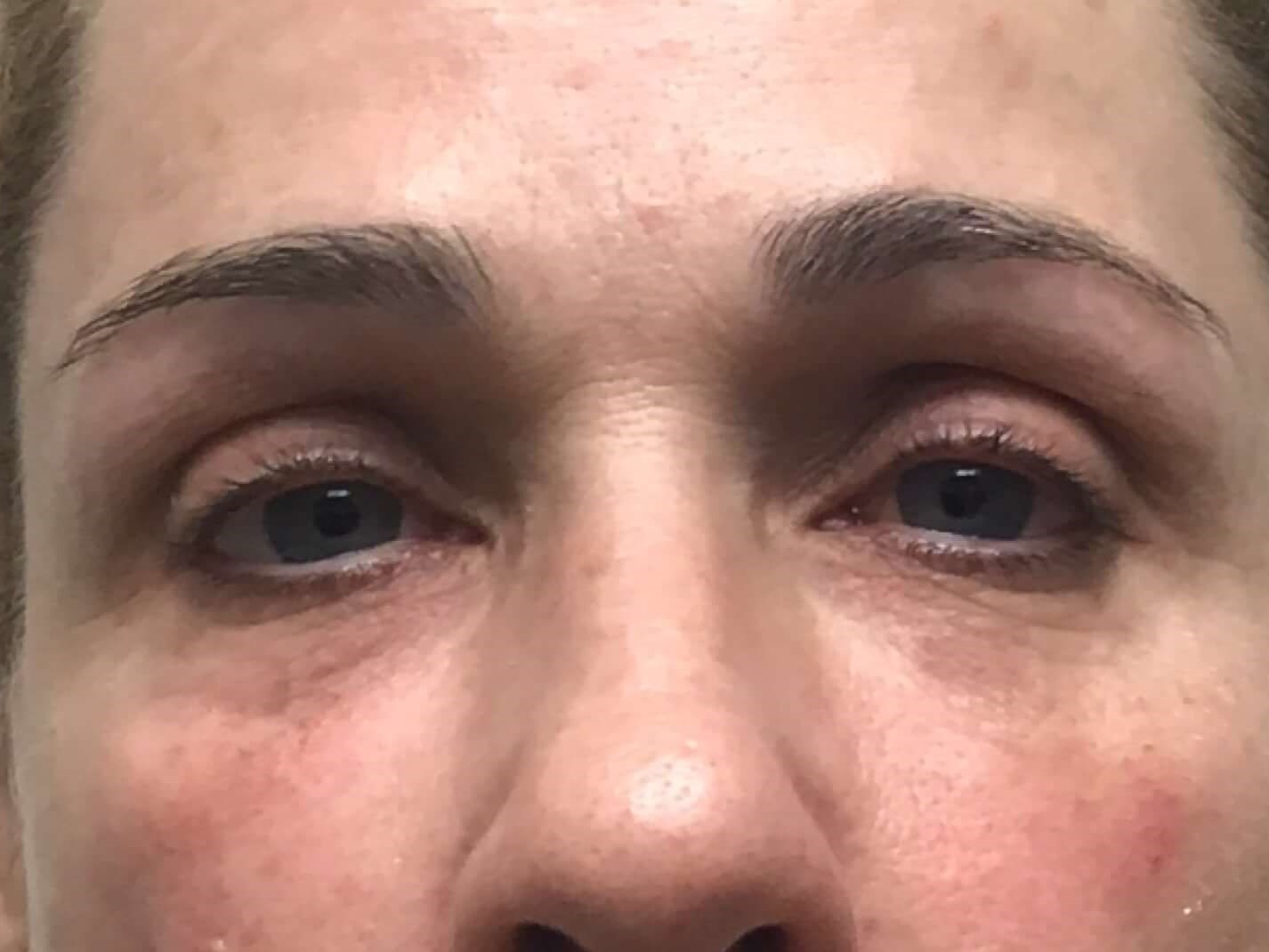 Tear Trough Filler After