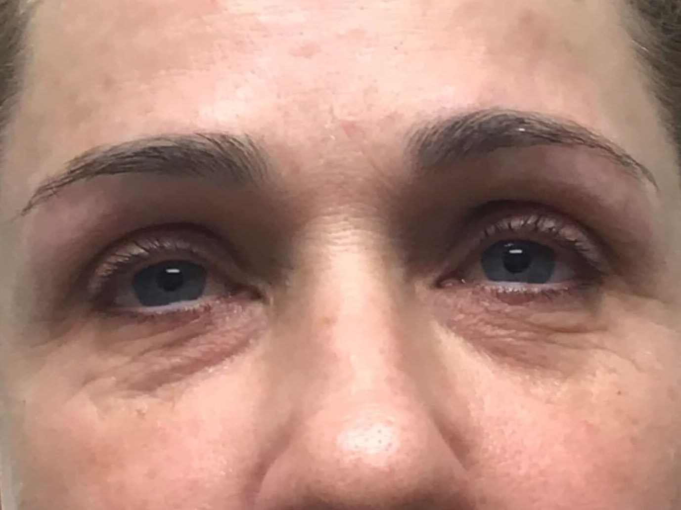 Tear Trough Filler Before